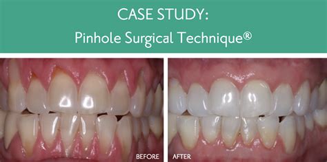 The Pinhole Gum Restoration Technique .